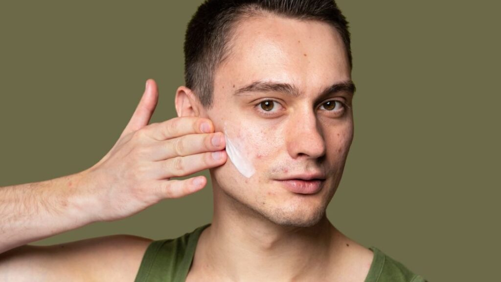 Acne prone skin