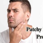 patchy beard problem