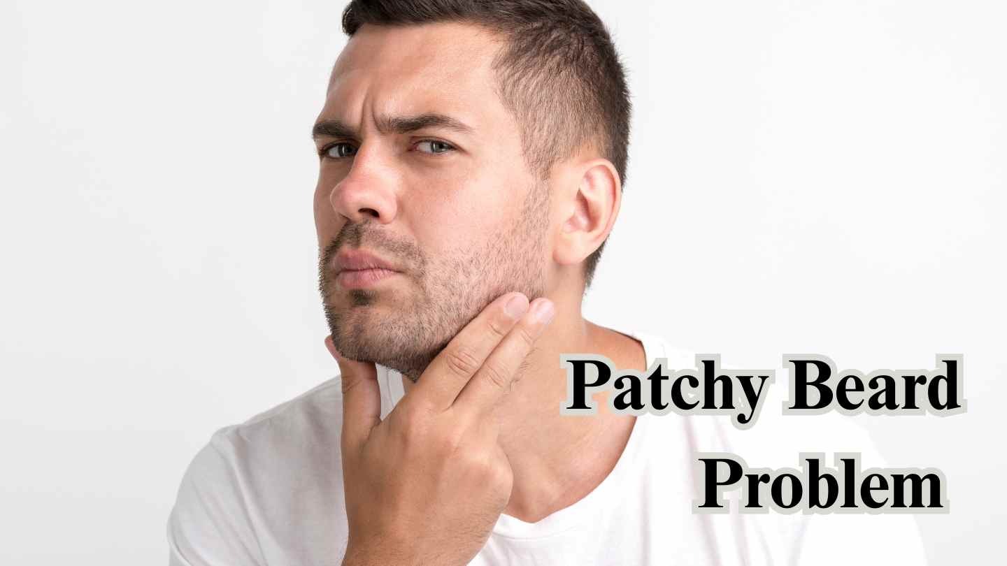 patchy beard problem